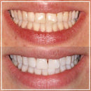 Smile White™ — El Lápiz Blanqueador 4X Más Potente