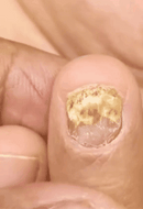 Tratamiento para los hongos en las uñas